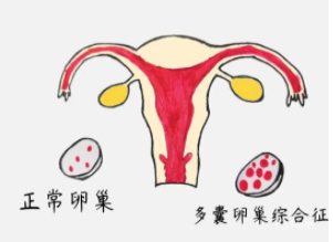 想变身&ldquo;幸孕&rdquo;女神吗？多囊卵巢备孕成功经验分享